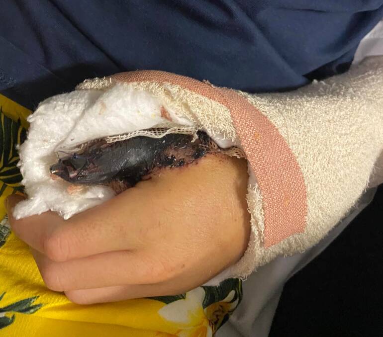 The injured thumb.